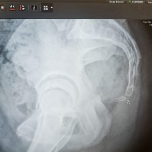 XRay image of Manda's injury while snowboarding